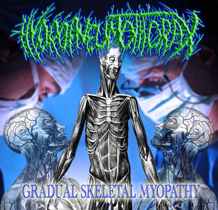 Hydropneumothorax — Gradual Skeletal Myopathy